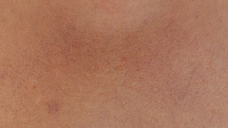 Rosazea – Ursachen & Behandlung